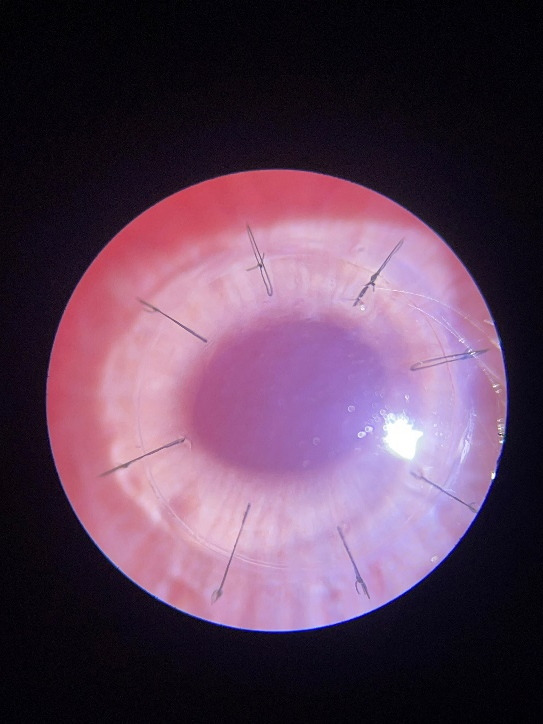 博創(chuàng  )生物人工角膜（E-COL）研發(fā)取得階段性重要成果
